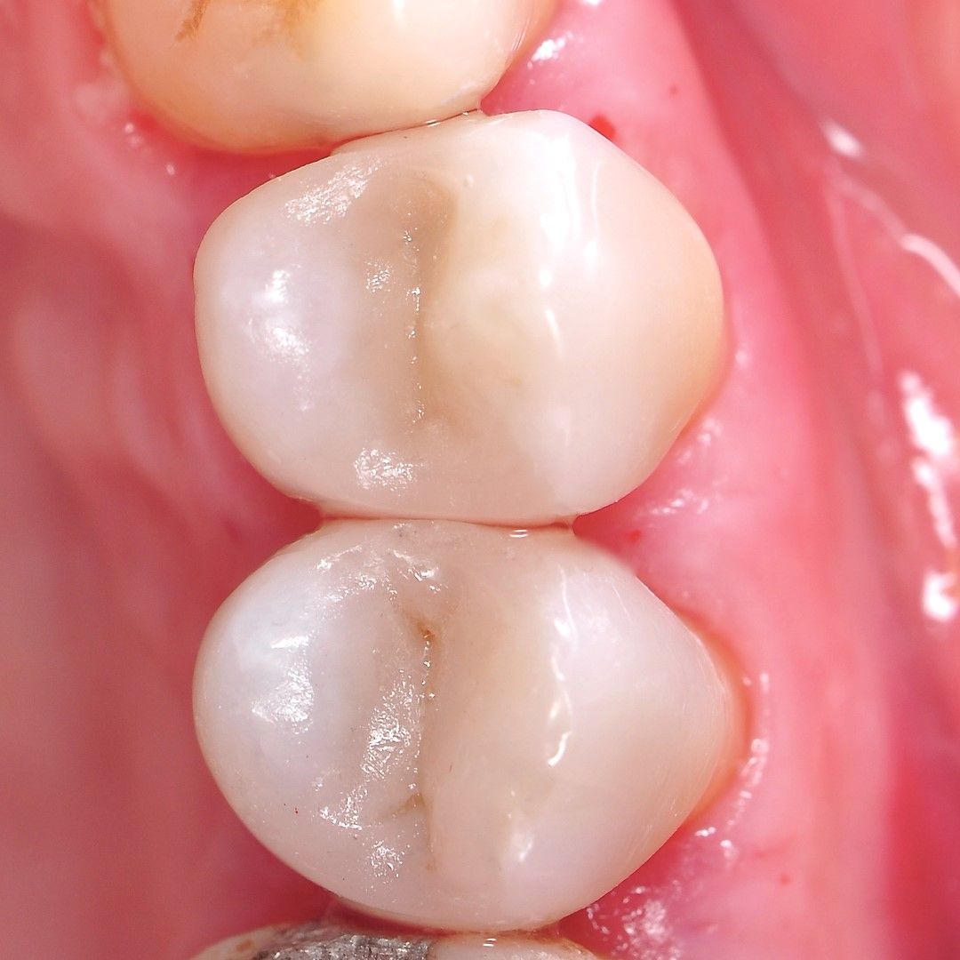 Back Tooth Filling Restoration after