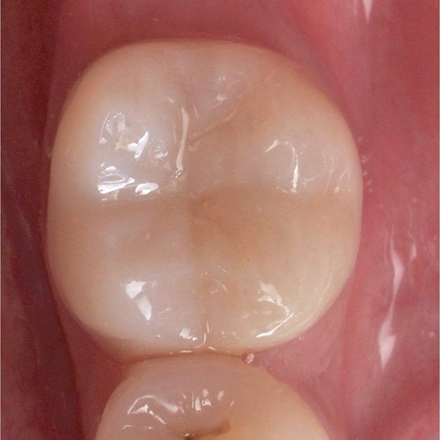 Back Teeth Repair of Grinding Fractures after