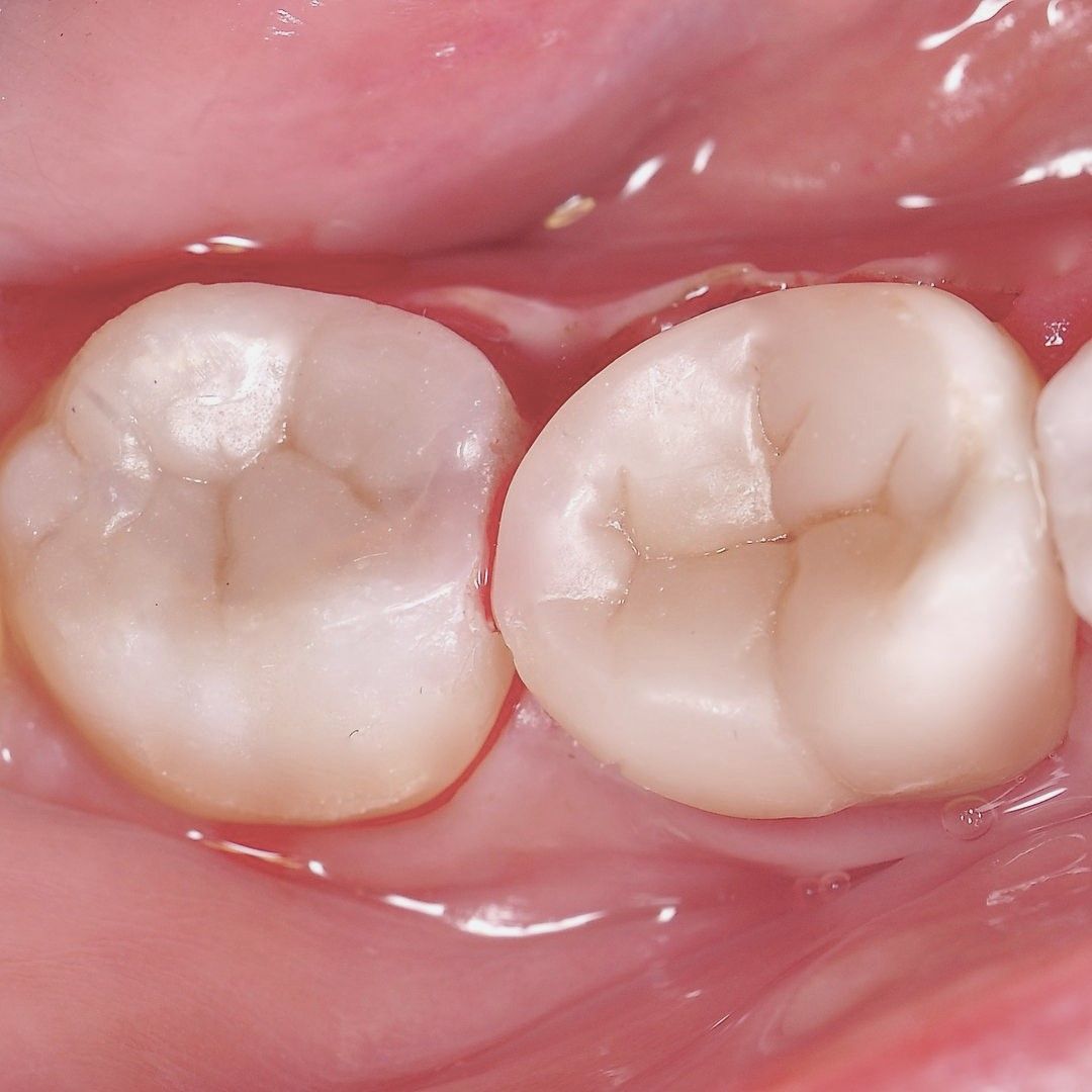 Back Teeth Repair of Grinding Fractures after
