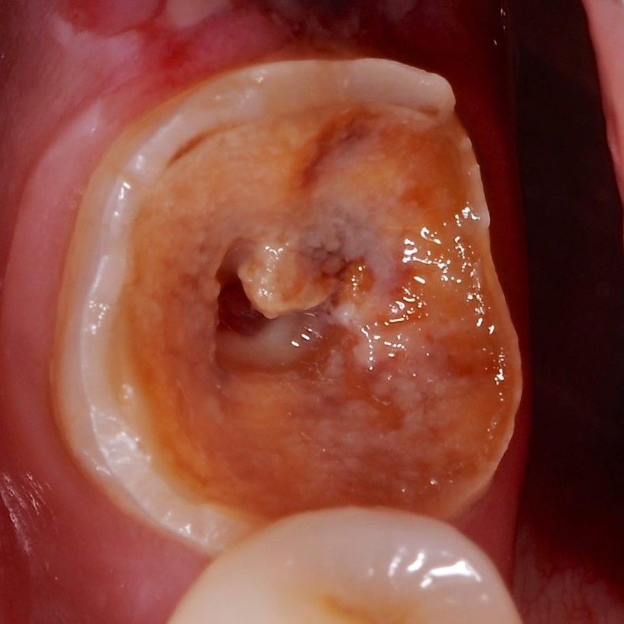 Back Teeth Repair of Grinding Fractures before